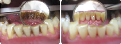 Отбеливание зубов - до и после. Случай 1.