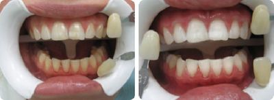 Отбеливание зубов - до и после. Случай 2.