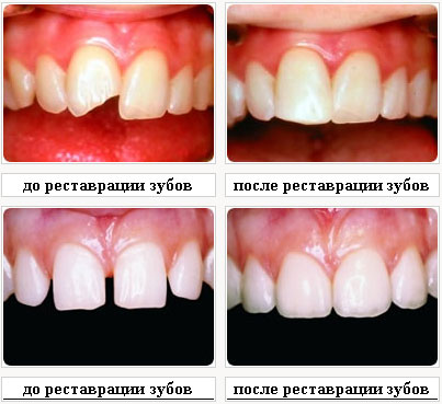 Восстановление зубов - ювелирная работа