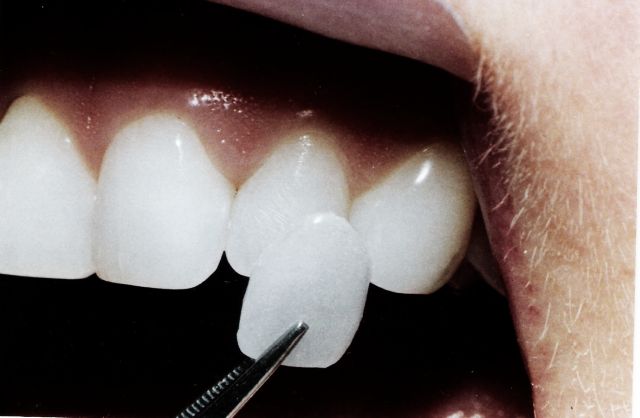 Рекомендация стоматолога - винир