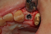 Имплантация зубов Случай №1 фото 9