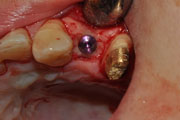 Имплантация зубов Случай №1 фото 10