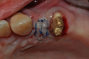 Имплантация зубов Случай №1 фото 11
