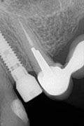 Имплантация зубов Случай №1 фото 13.1