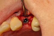 Имплантация зубов Случай №1 фото 13
