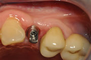 Имплантация зубов Случай №1 фото 15