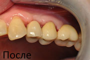 имплантация зубов фото случай  №1