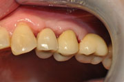 Имплантация зубов Случай №1 фото 16