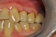 Имплантация зубов Случай №1 фото 17