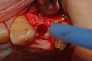 Имплантация зубов Случай №1 фото 8