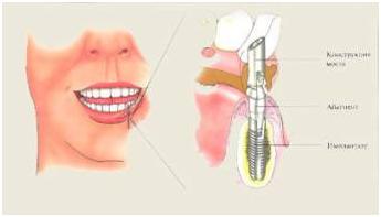 Какой бывает имплантация зубов