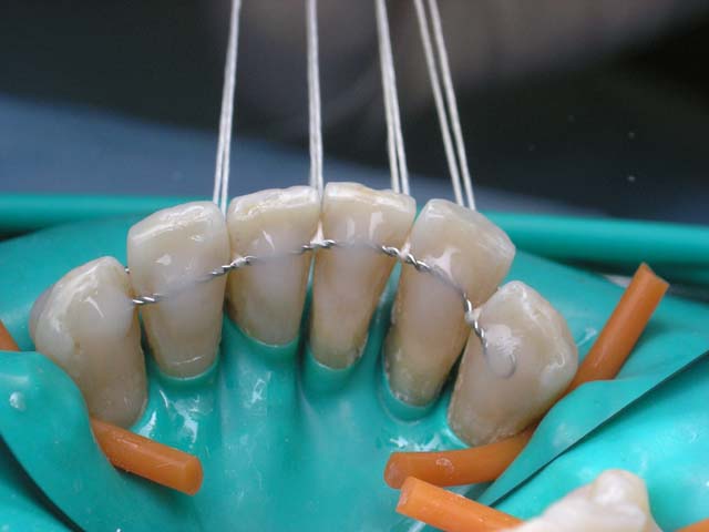 Шинирование зубов съемными конструкциями