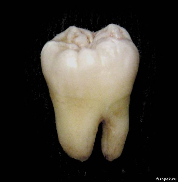 Устранение дефектов зубного ряда посредством пересадки зубов мудрости