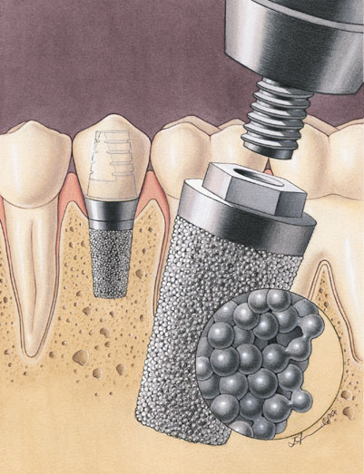 Имплантация зубов: что и как происходит?