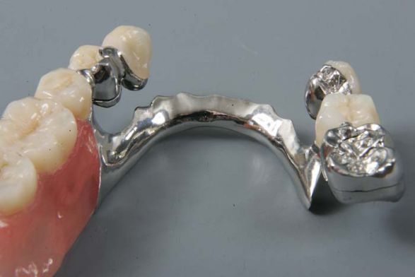 Протезирование мостовидными зубными протезами