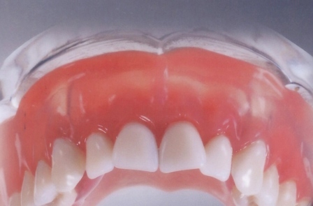 Быстрая адаптация к съемным зубным протезам