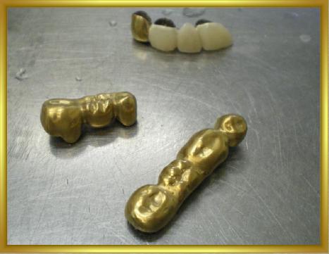 Использование золота для мостовидных протезов