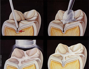 реставрация жевательных зубов
