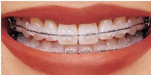 сапфировые зубы