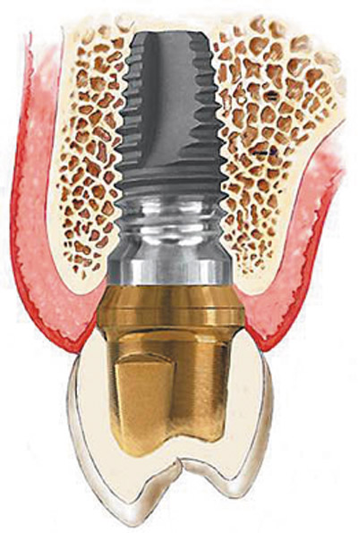 Современное протезирование - имплантация зубов!