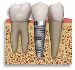 История имплантации: как были изобретены идеальные зубы
