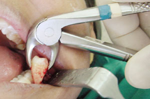 осложнения после удаления зубов