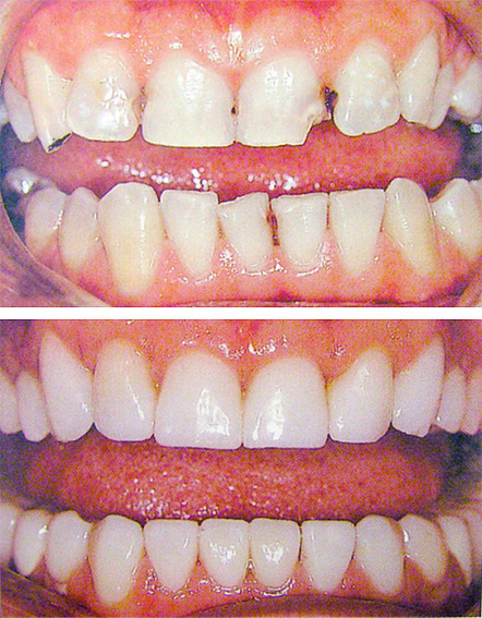 Виды реставраций зубов