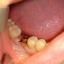 протезирование после удаления зуба