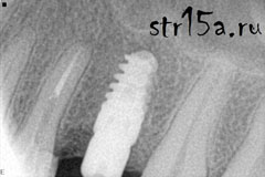 Имплантация зубов Случай №2 фото 1-10