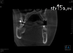 Имплантация зубов Случай №2 фото 1-2