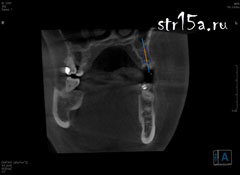 Имплантация зубов Случай №2 фото 1-5