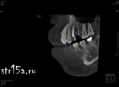 Имплантация зубов Случай №2 фото 1-6
