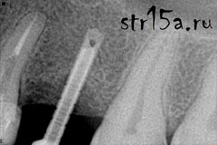 Имплантация зубов Случай №2 фото 1-8