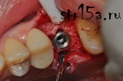 Имплантация зубов Случай №2 фото 1-9