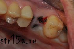 Имплантация зубов Случай №2 фото 1