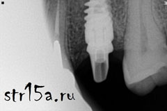 Имплантация зубов Случай №2 фото 1-3