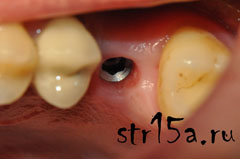 Имплантация зубов Случай №2 фото 2