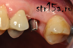 Имплантация зубов Случай №2 фото 4