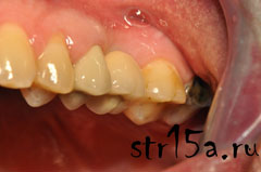 Имплантация зубов Случай №2 фото 5