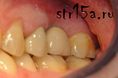 Имплантация зубов Случай №2 фото 6