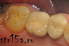 Имплантация зубов Случай №2 фото 7