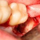 рекомендации после удаления зуба