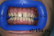 Отбеливание зубов Случай №1 фото До