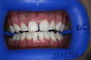 Отбеливание зубов Случай №1 фото Псоле