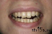 Отбеливание зубов Случай №2 фото До