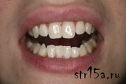 Отбеливание зубов Случай №2 После