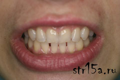 Отбеливание зубов Случай №3 фото До