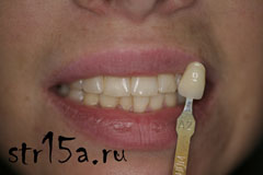 Отбеливание зубов Случай №5 фото До