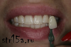 Отбеливание зубов Случай №5 фото После