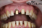 Протезирование зубов Случай №1 фото 1